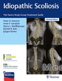 Idiopathic Scoliosis