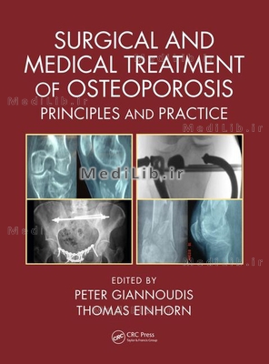 Surgical and Medical Treatment of Osteoporosis: Principles and Practice