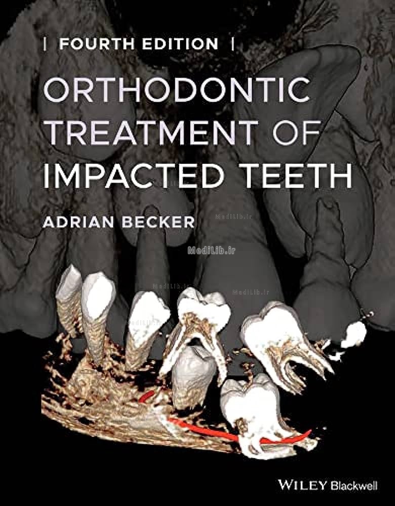 Orthodontic Treatment of Impacted Teeth