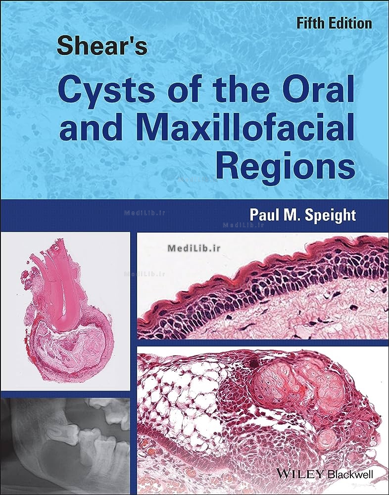 Shear's Cysts of the Oral and Maxillofacial Regions