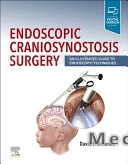 Endoscopic Craniosynostosis Surgery